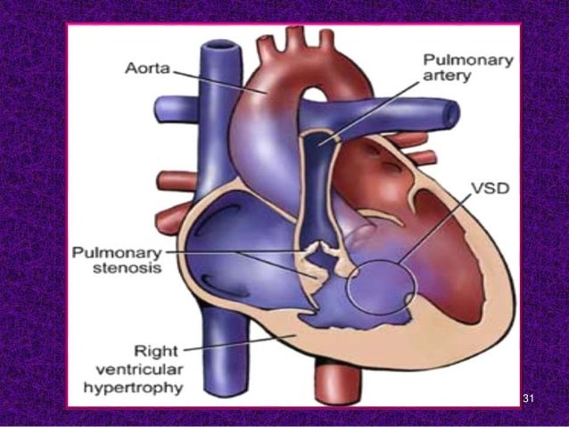what is an example of a congenital heart defect